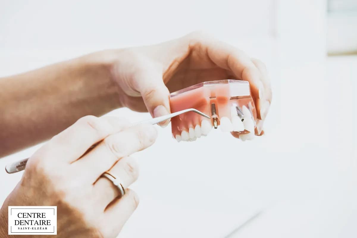 Maintenir ses implants à long terme