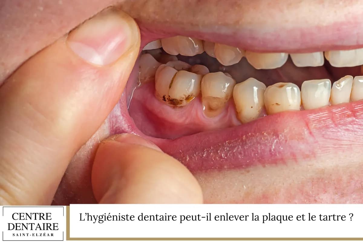 L’hygiéniste dentaire peut-il enlever la plaque et le tartre ?