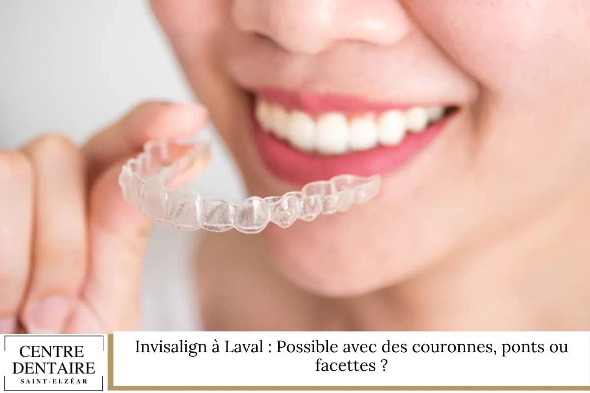 Invisalign à Laval : Possible avec des couronnes, ponts ou facettes ?