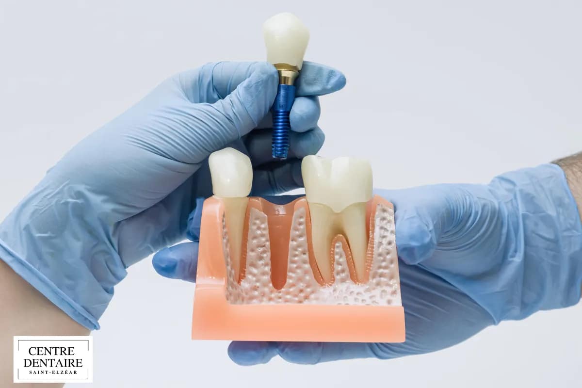 Pourquoi un implant dentaire peut ne pas tenir