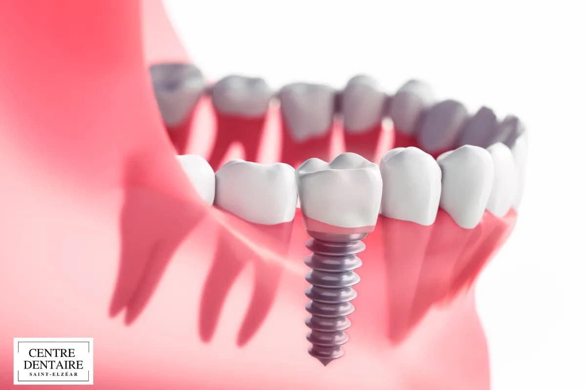 Le processus de pose d’un implant dentaire