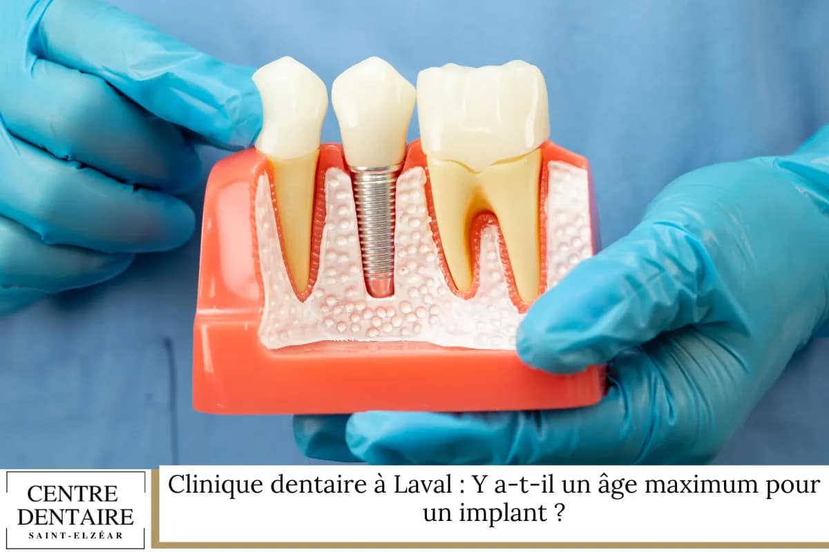 Clinique dentaire à Laval : Y a-t-il un âge maximum pour un implant ?