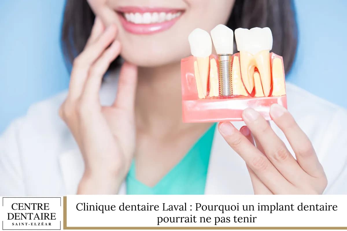 Clinique dentaire Laval : Pourquoi un implant dentaire pourrait ne pas tenir