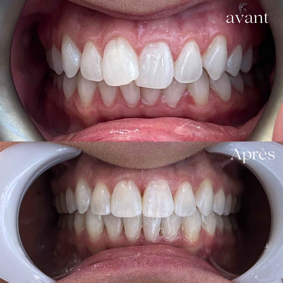 invisalign