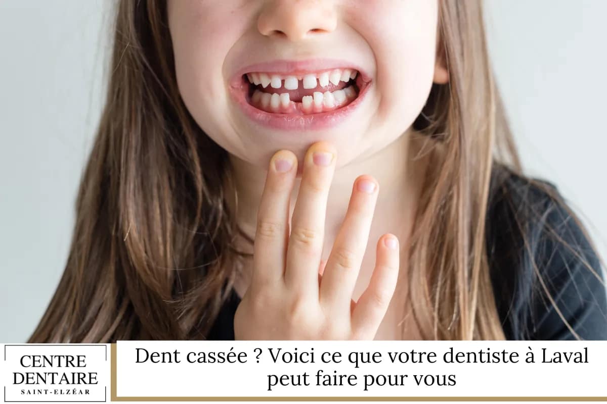 Dent cassée Voici ce que votre dentiste à Laval peut faire pour vous