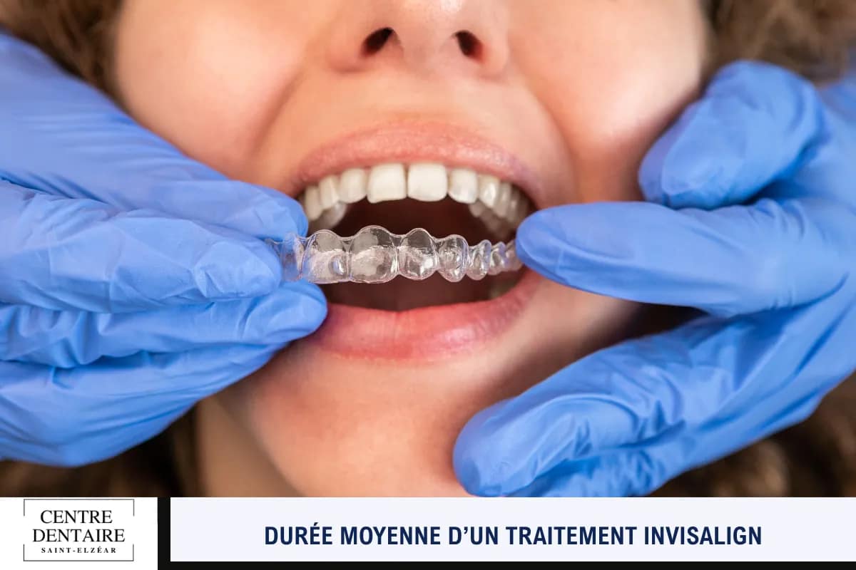 Durée moyenne d’un traitement Invisalign