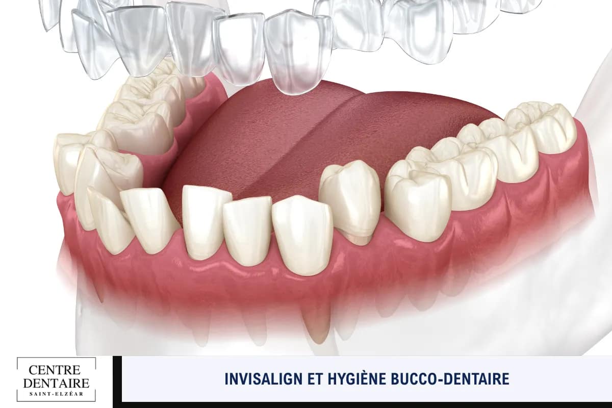 Invisalign et hygiène bucco-dentaire