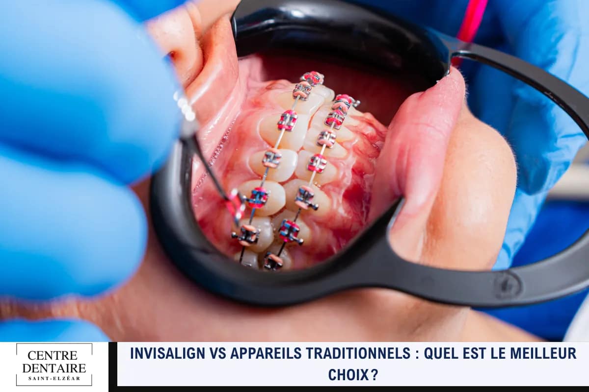 Invisalign vs appareils traditionnels _ quel est le meilleur choix