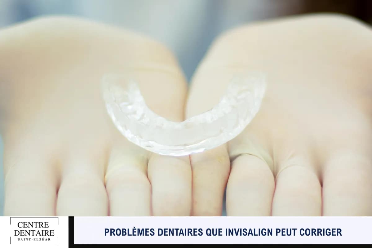 Problèmes dentaires que Invisalign peut corriger