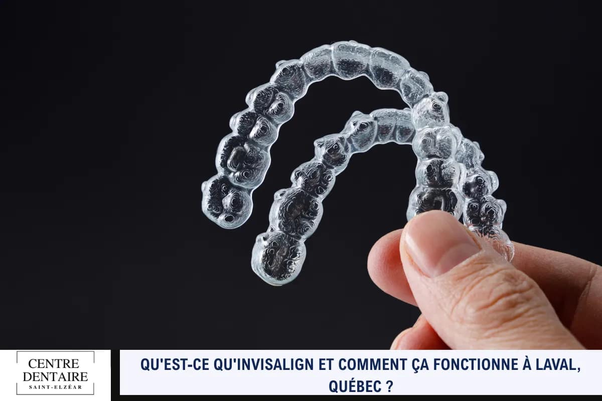 Qu'est-ce qu'Invisalign et comment ça fonctionne à Laval, Québec
