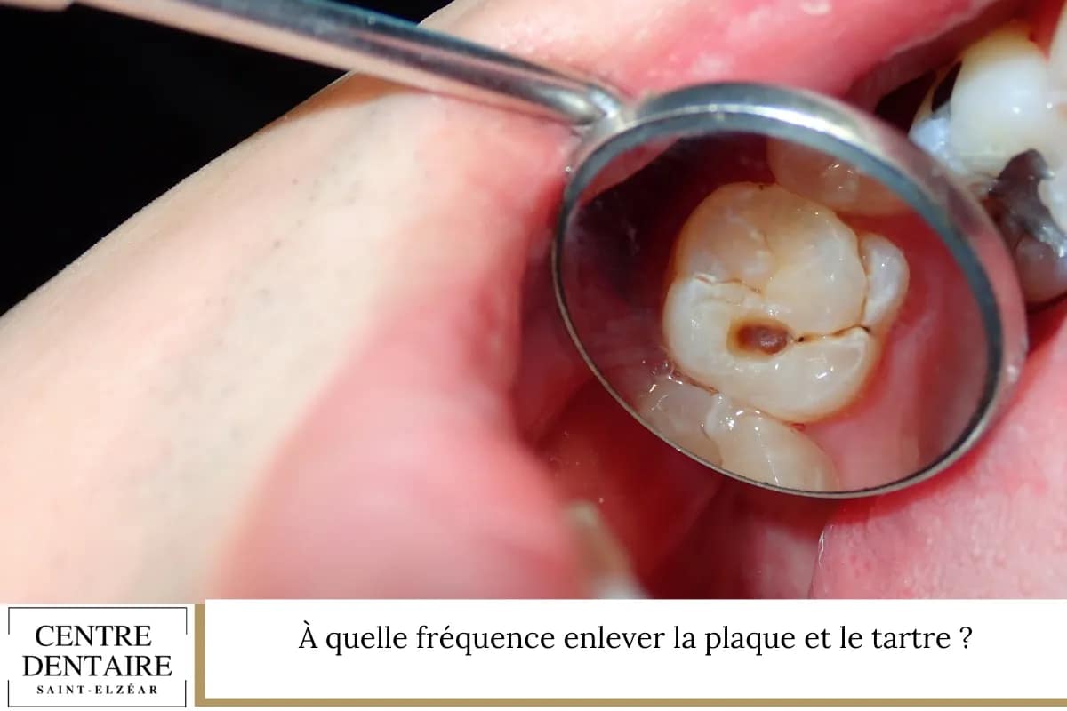 À quelle fréquence enlever la plaque et le tartre ?