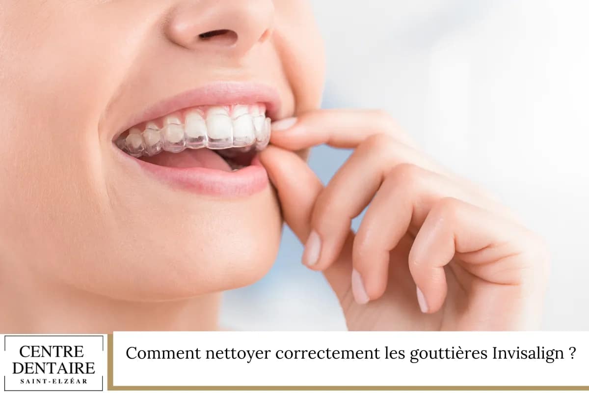 Comment nettoyer correctement les gouttières Invisalign?