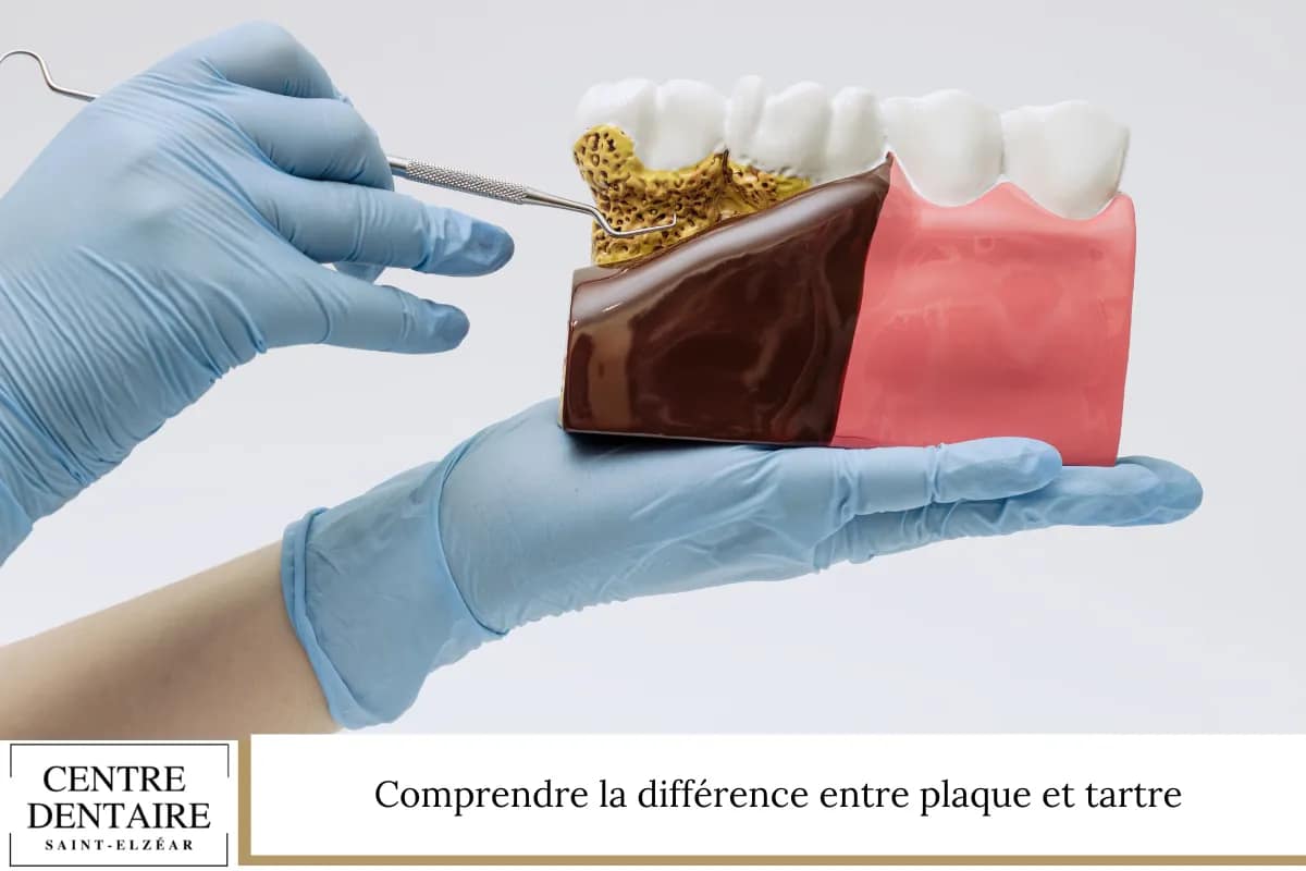 Comprendre la différence entre plaque et tartre