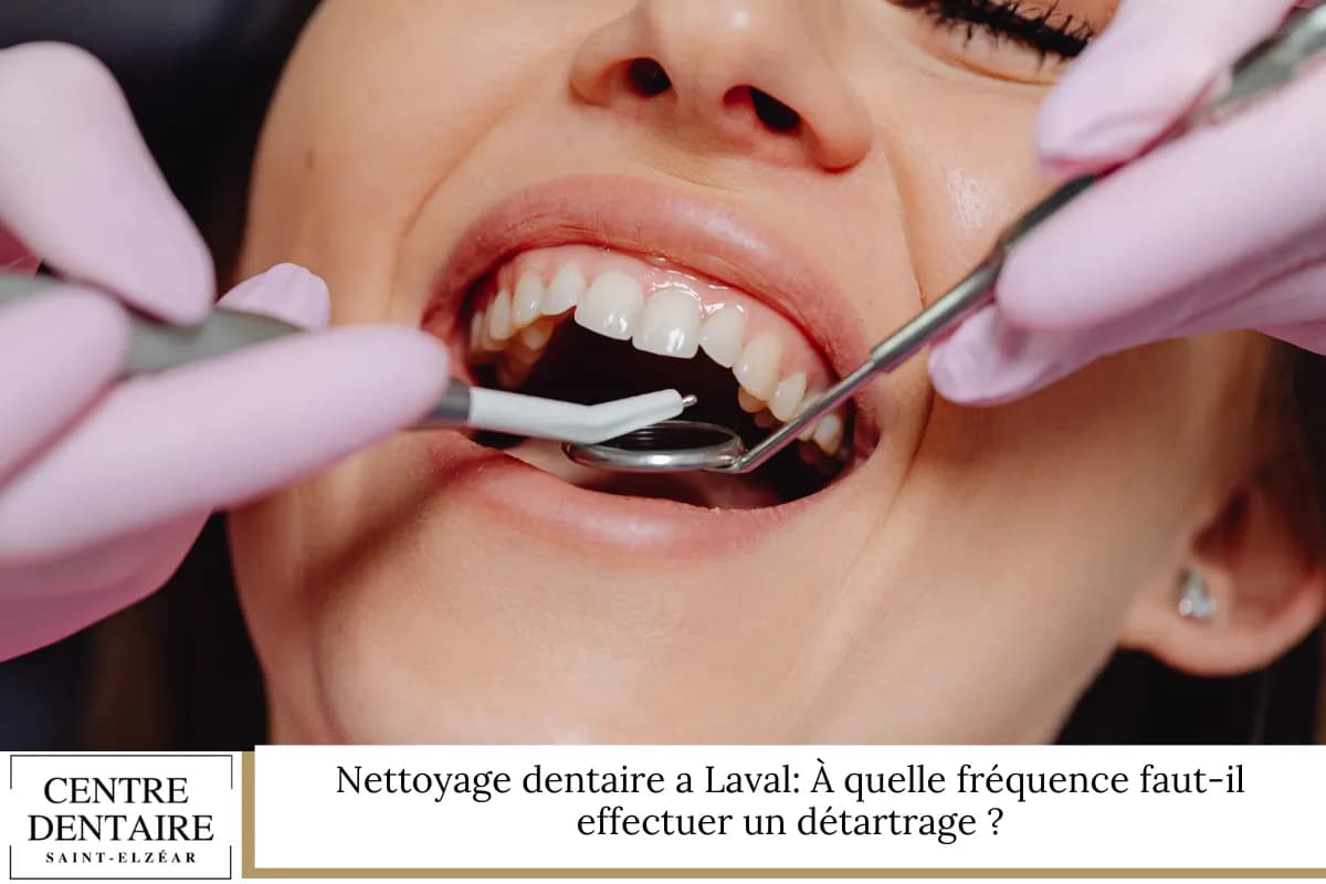 Nettoyage dentaire a Laval: À quelle fréquence faut-il effectuer un détartrage ?