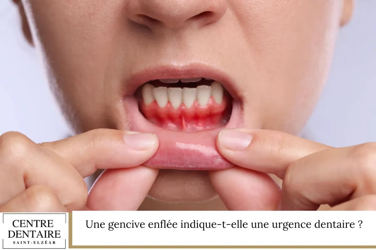 Une gencive enflée indique-t-elle une urgence dentaire ?