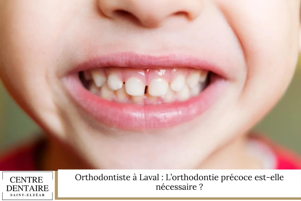 Orthodontiste à Laval : L’orthodontie précoce est-elle nécessaire ?