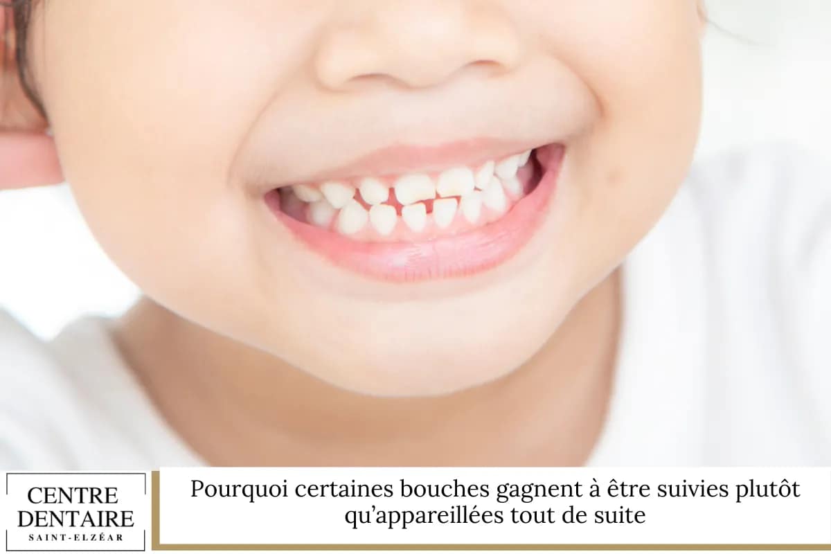 Pourquoi certaines bouches gagnent à être suivies plutôt qu’appareillées tout de suite