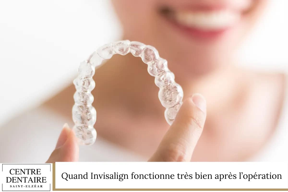 Quand Invisalign fonctionne très bien après l’opération