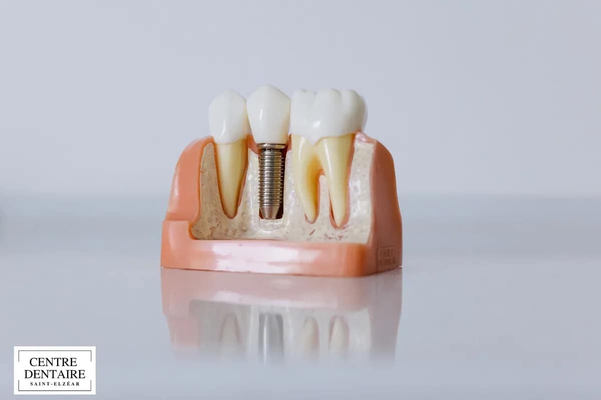 Les bases d’un implant dentaire réussi