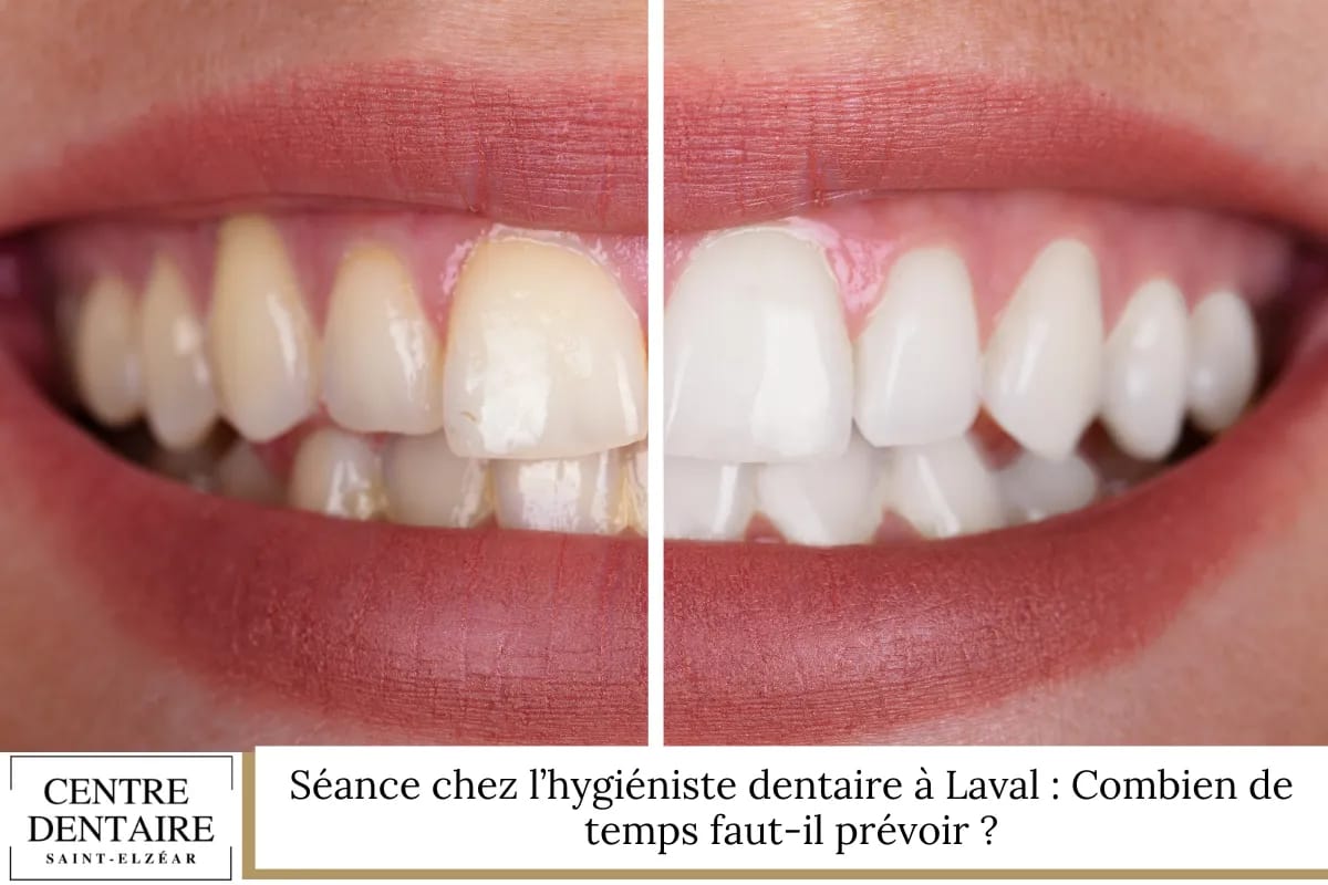 Séance chez l’hygiéniste dentaire à Laval : Combien de temps faut-il prévoir ?