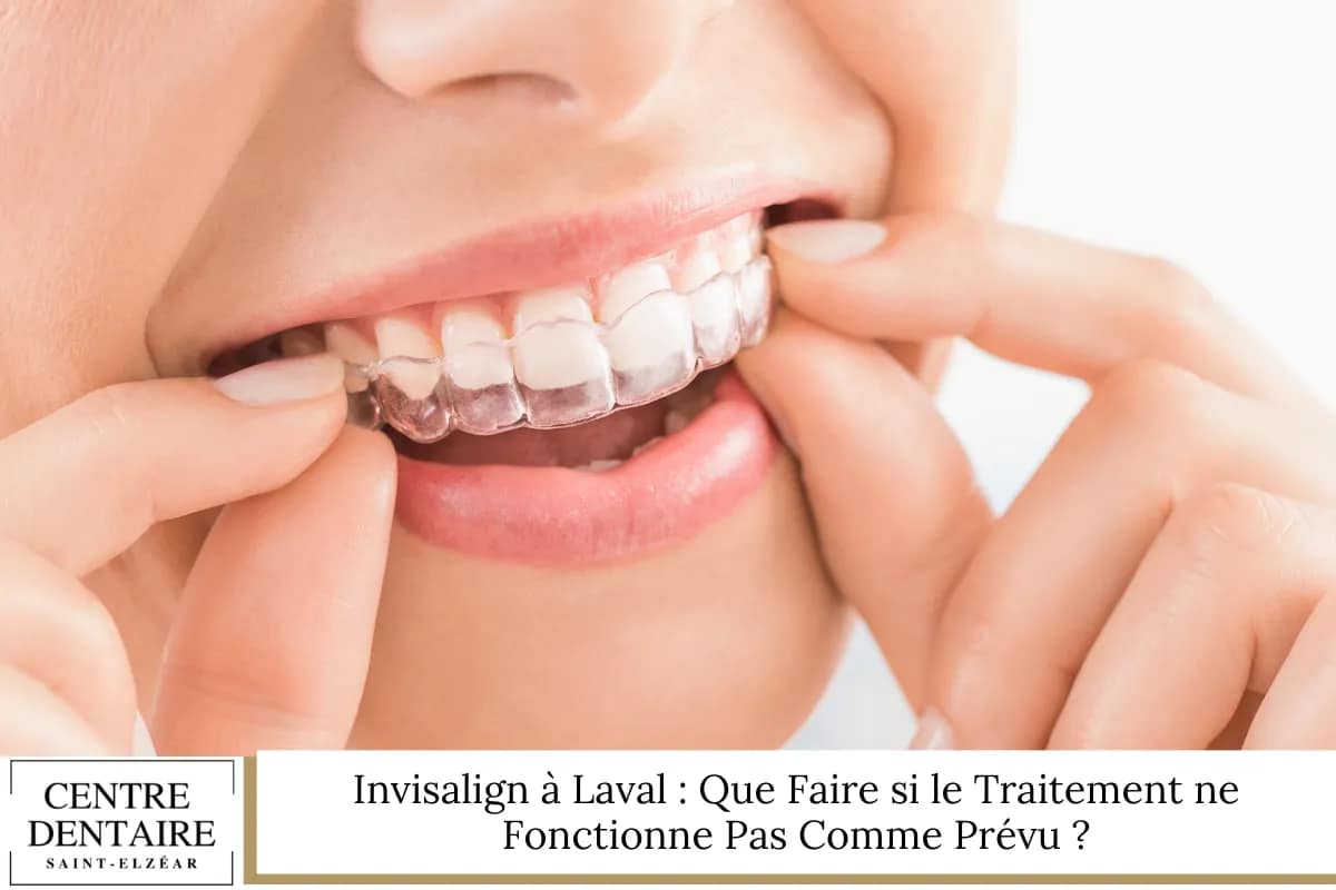 Invisalign à Laval : Que Faire si le Traitement ne Fonctionne Pas Comme Prévu ?