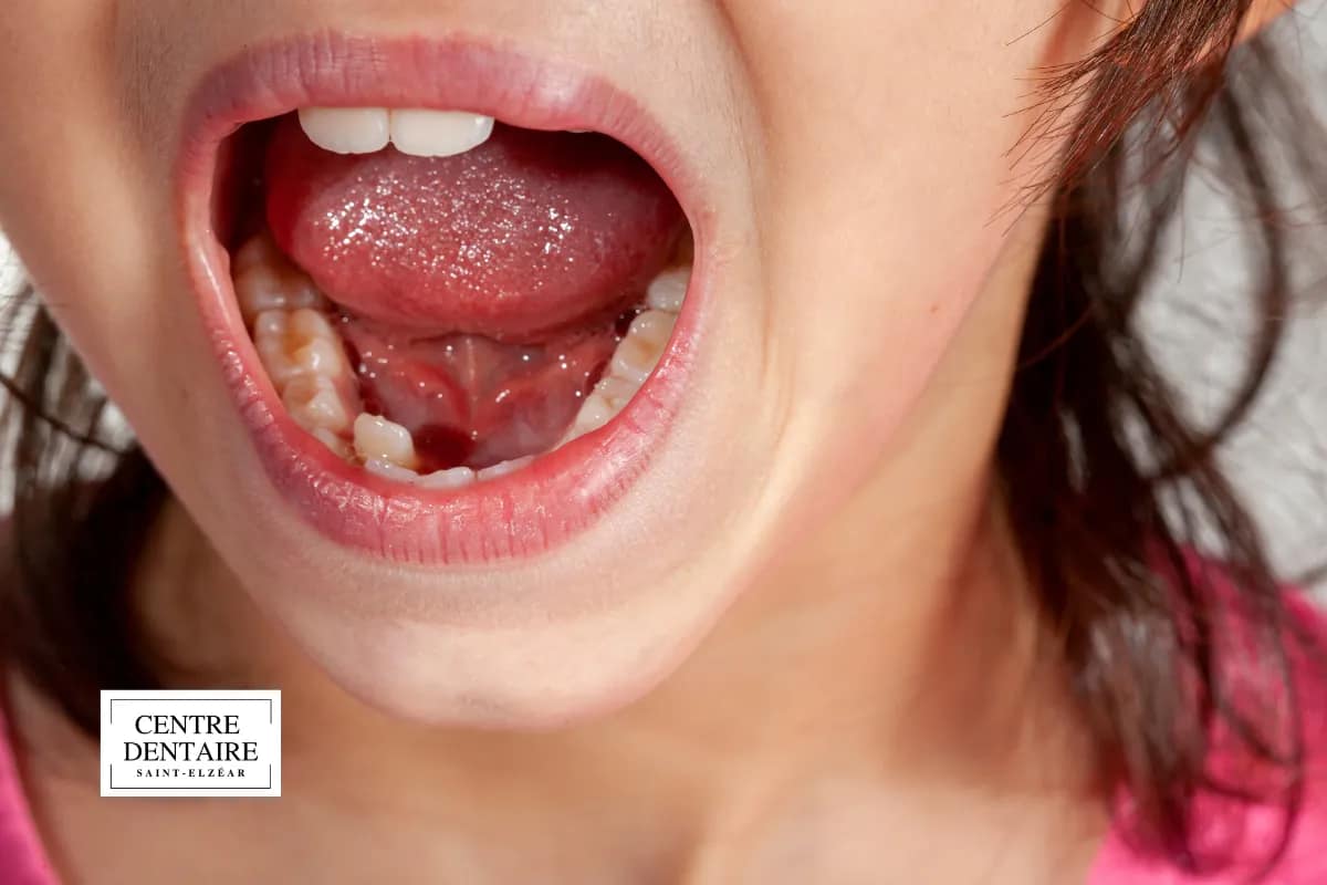 Les principales causes d'une mâchoire mal alignée chez l'enfant