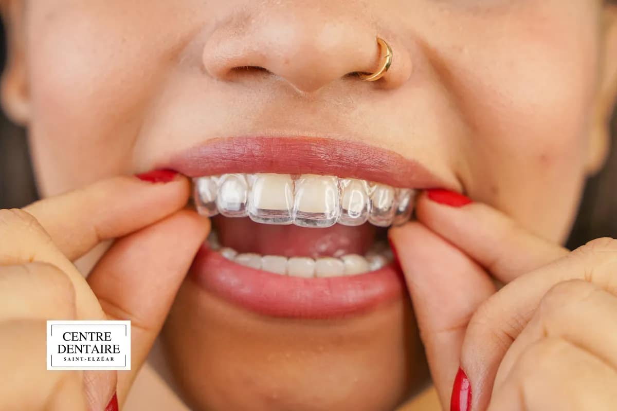 Pourquoi les dents ont tendance à bouger après un traitement Invisalign