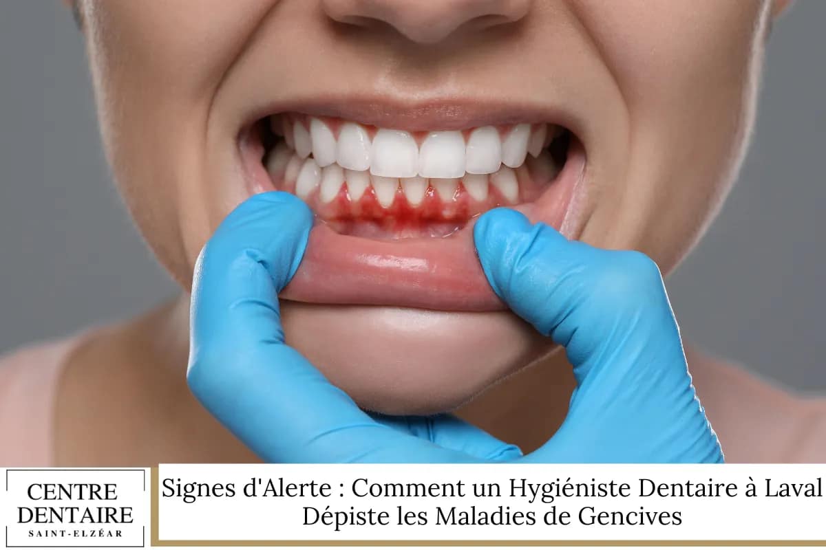 Signes d'Alerte : Comment un Hygiéniste Dentaire à Laval Dépiste les Maladies de Gencives
