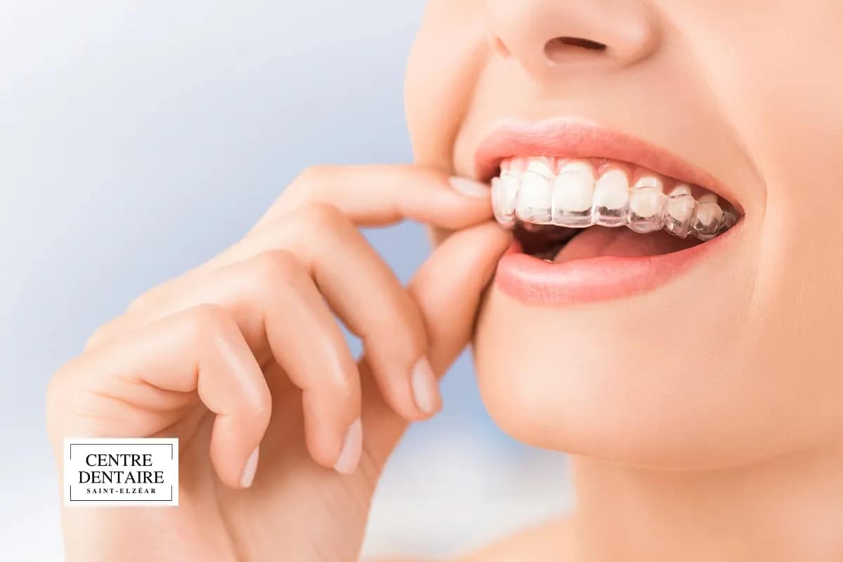 Suivi en clinique dentaire à Laval : ce que vérifie votre dentiste après Invisalign