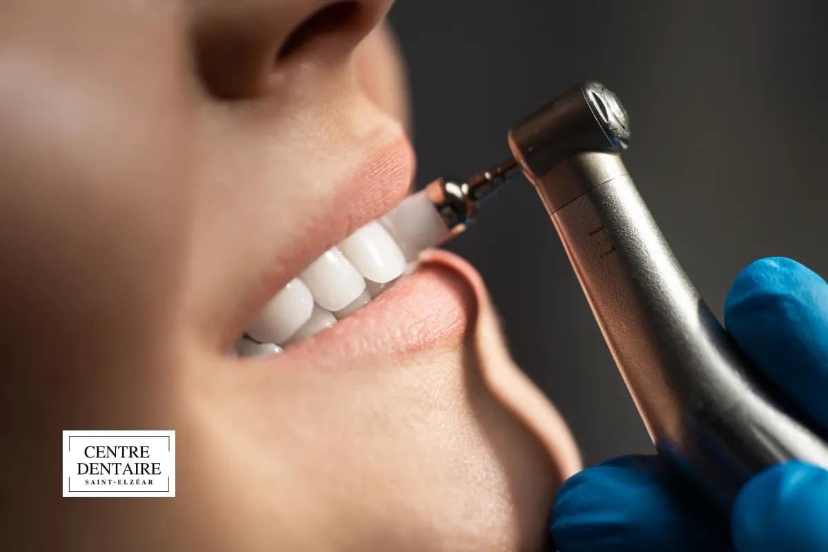 Surfaçage radiculaire (root planing) : lisser les racines pour stabiliser les gencives