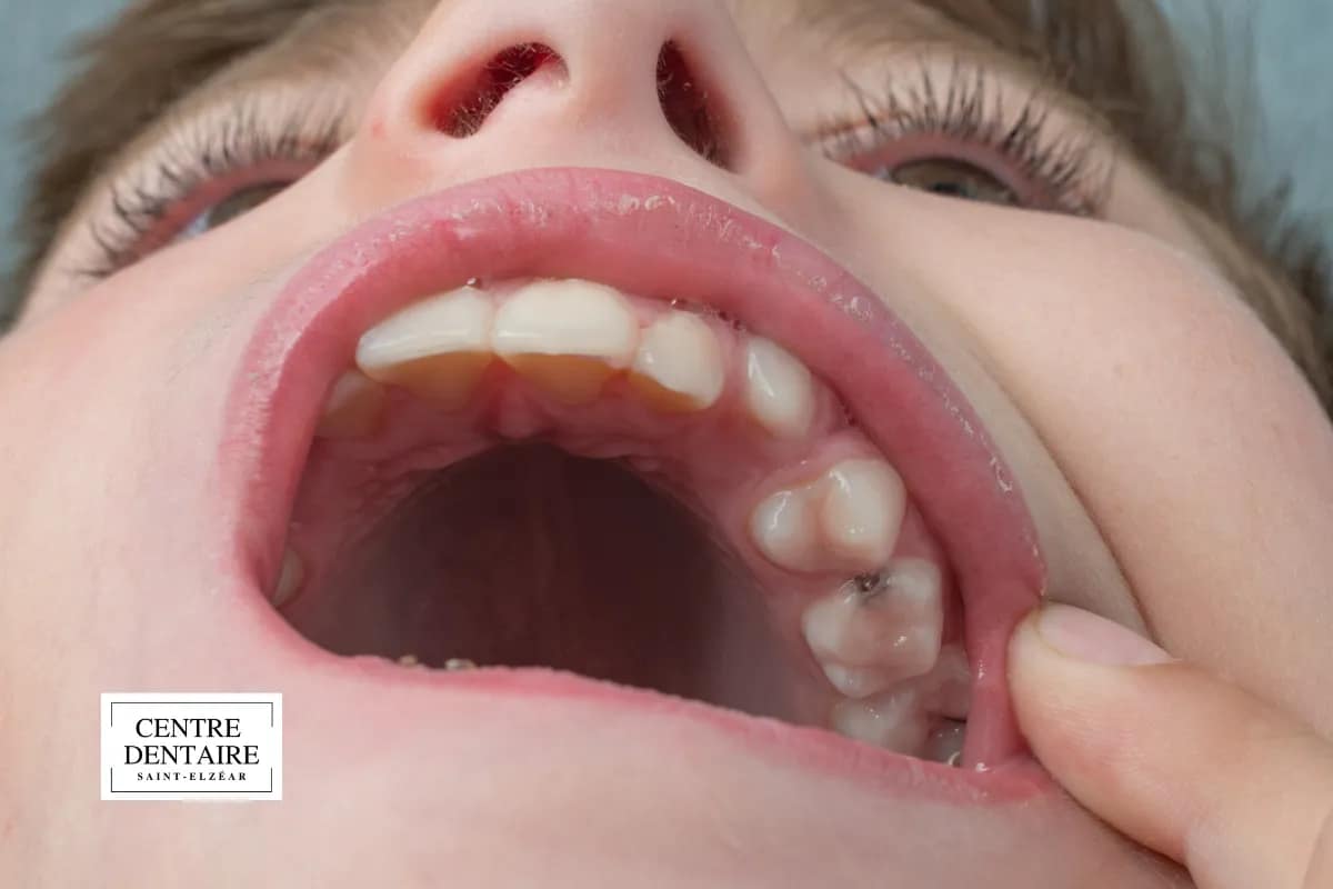 Traitement orthodontique complet de la mâchoire mal alignée à l'adolescence