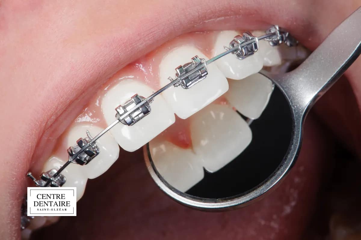 Comment un traitement orthodontique peut améliorer la parole