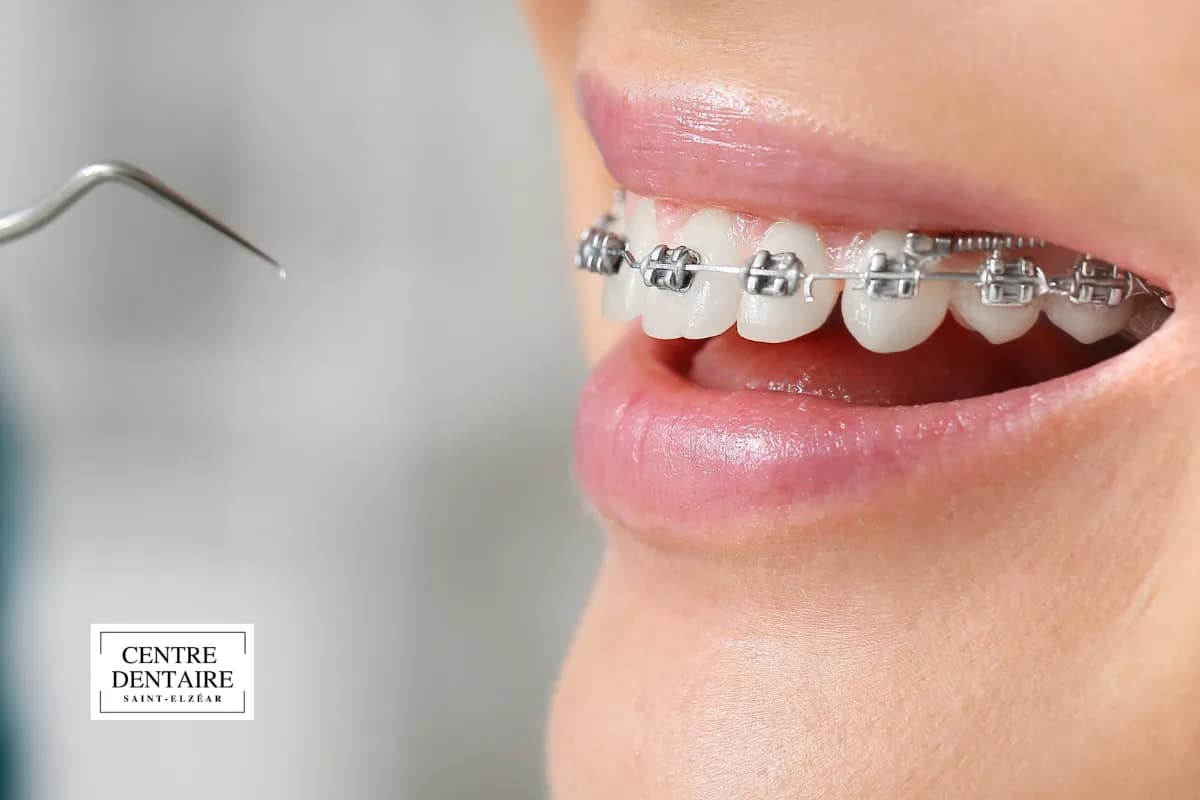 Hygiène, habitudes de vie et santé globale pendant un traitement orthodontique