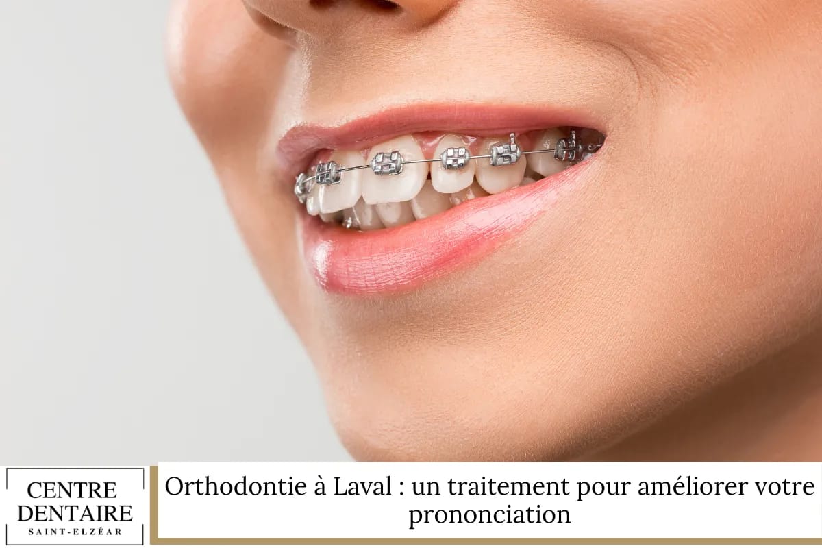 Orthodontie à Laval : un traitement pour améliorer votre prononciation