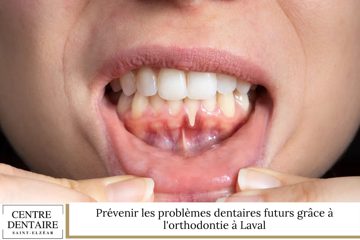 Prévenir les problèmes dentaires futurs grâce à l'orthodontie à Laval