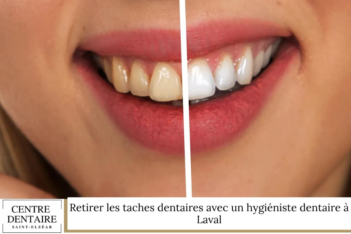 Retirer les taches dentaires avec un hygiéniste dentaire à Laval