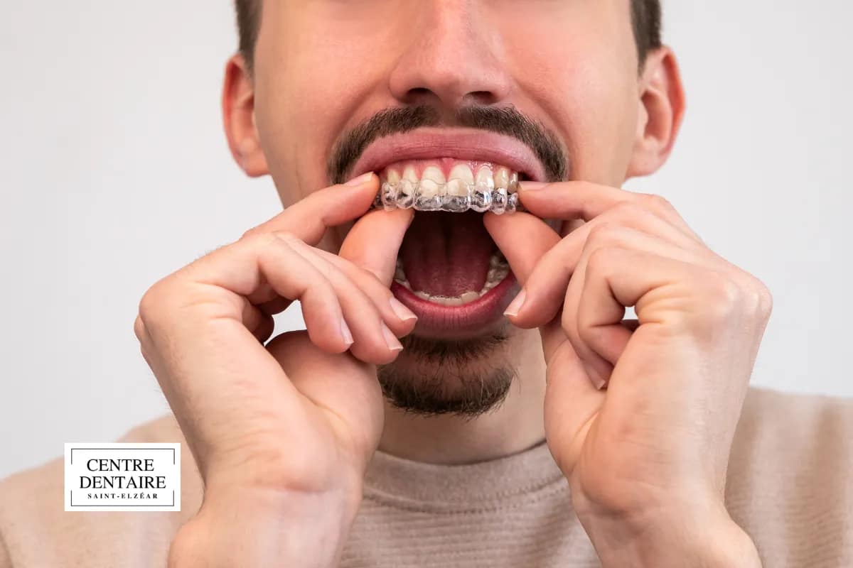 Situations où Invisalign n'est peut-être pas la meilleure option