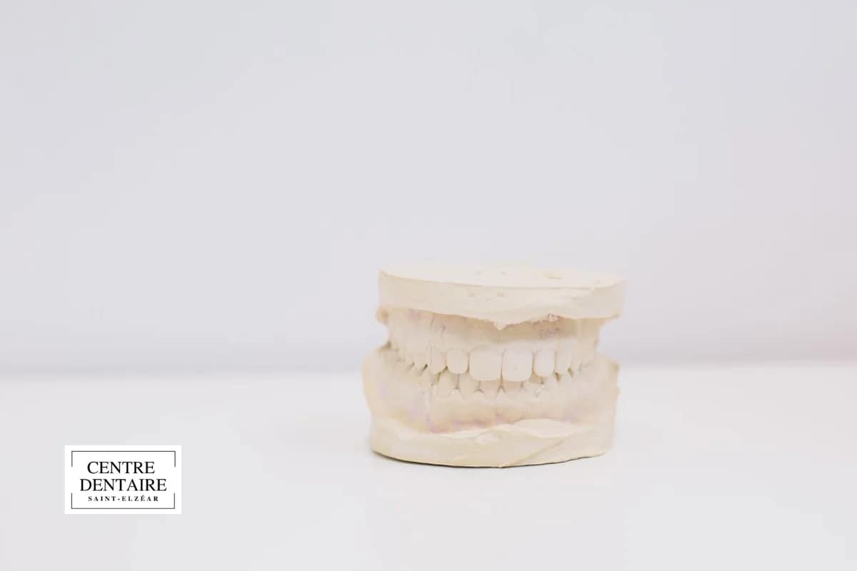 Invisalign et supraclusion : réponse rapide pour les patients de Laval