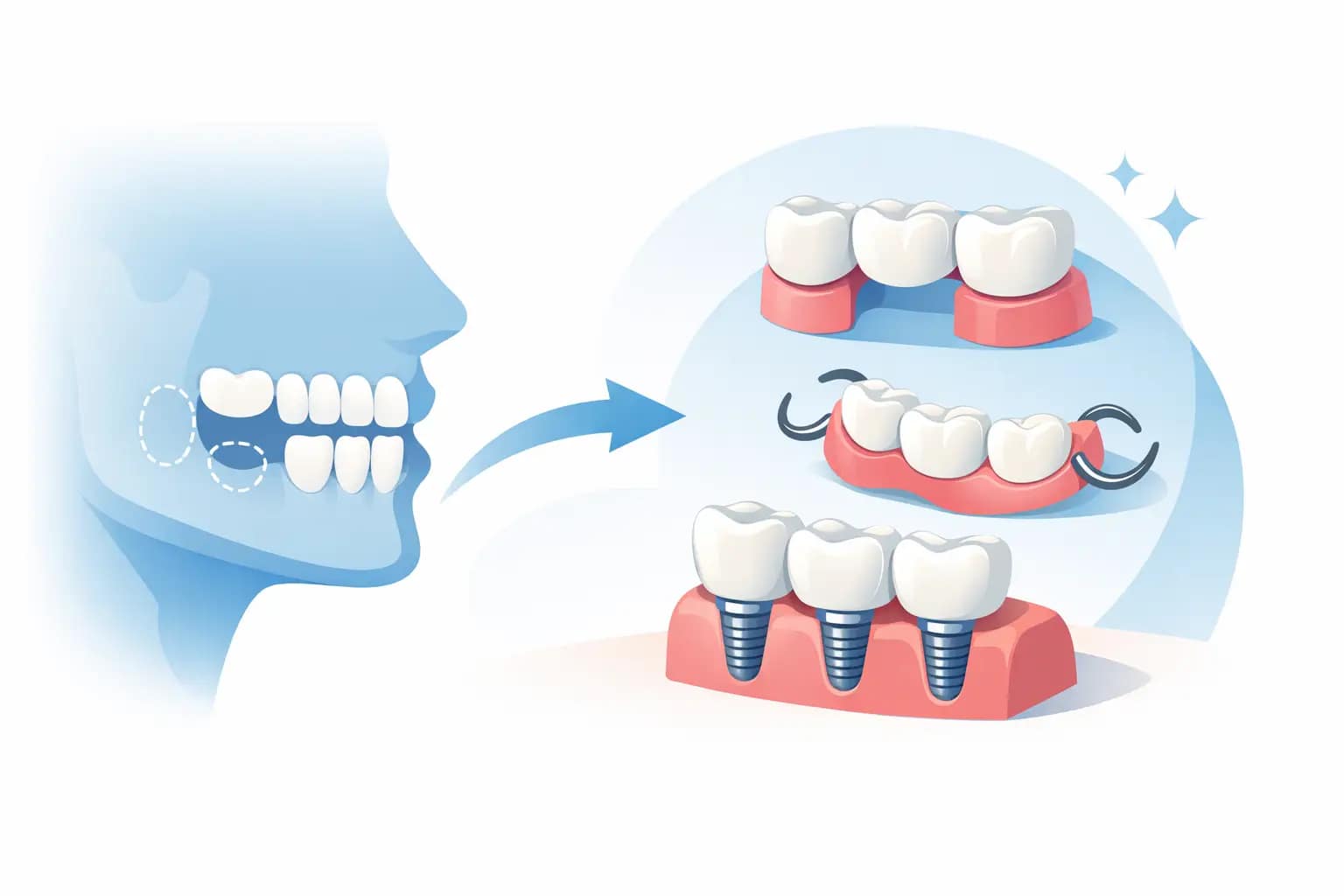 Peut-on remplacer plusieurs dents manquantes ?