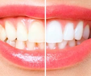 Laval Dental Cleaning – Professional Dental Care in Sainte-Dorothée, Laval, QC