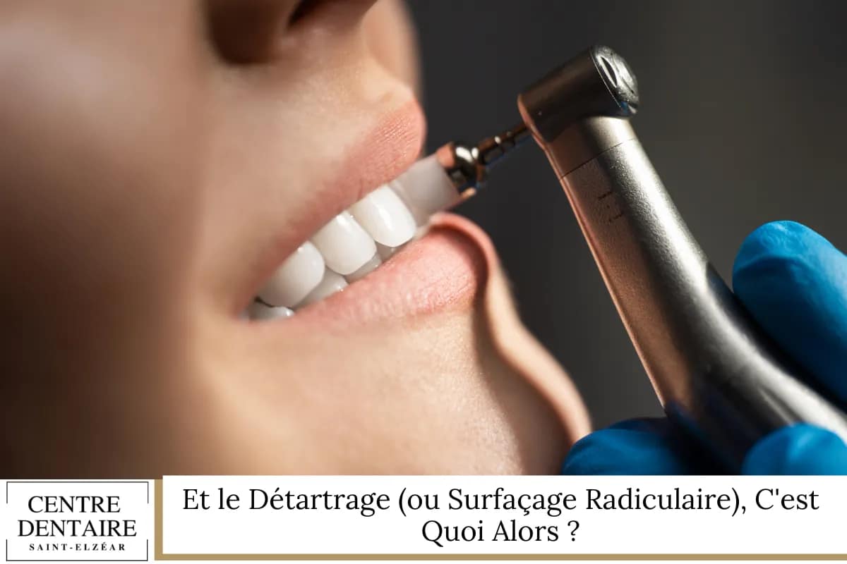 Et le Détartrage (ou Surfaçage Radiculaire), C_est Quoi Alors