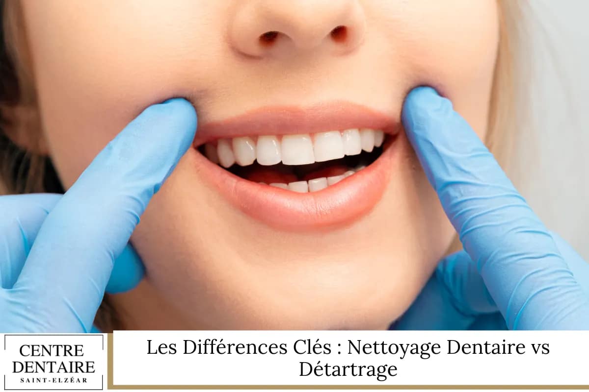 Et le Détartrage (ou Surfaçage Radiculaire), C_est Quoi Alors (1)