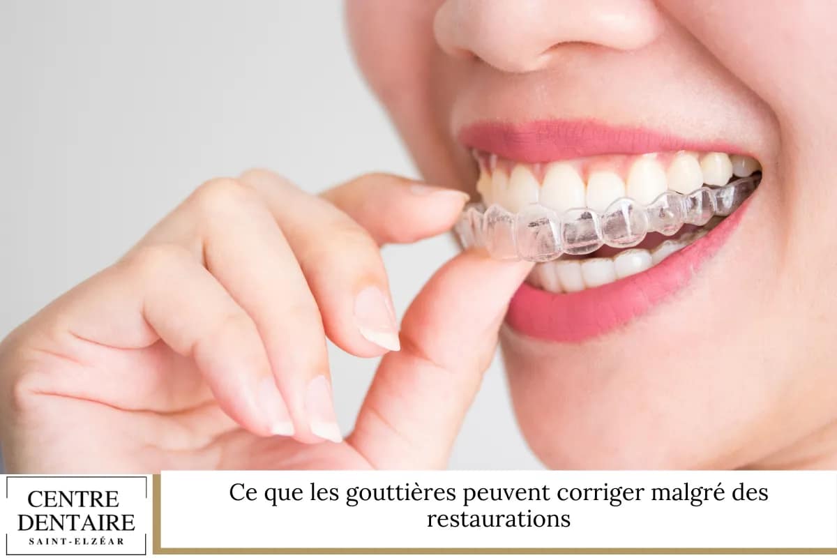 Ce que les gouttières peuvent corriger malgré des restaurations