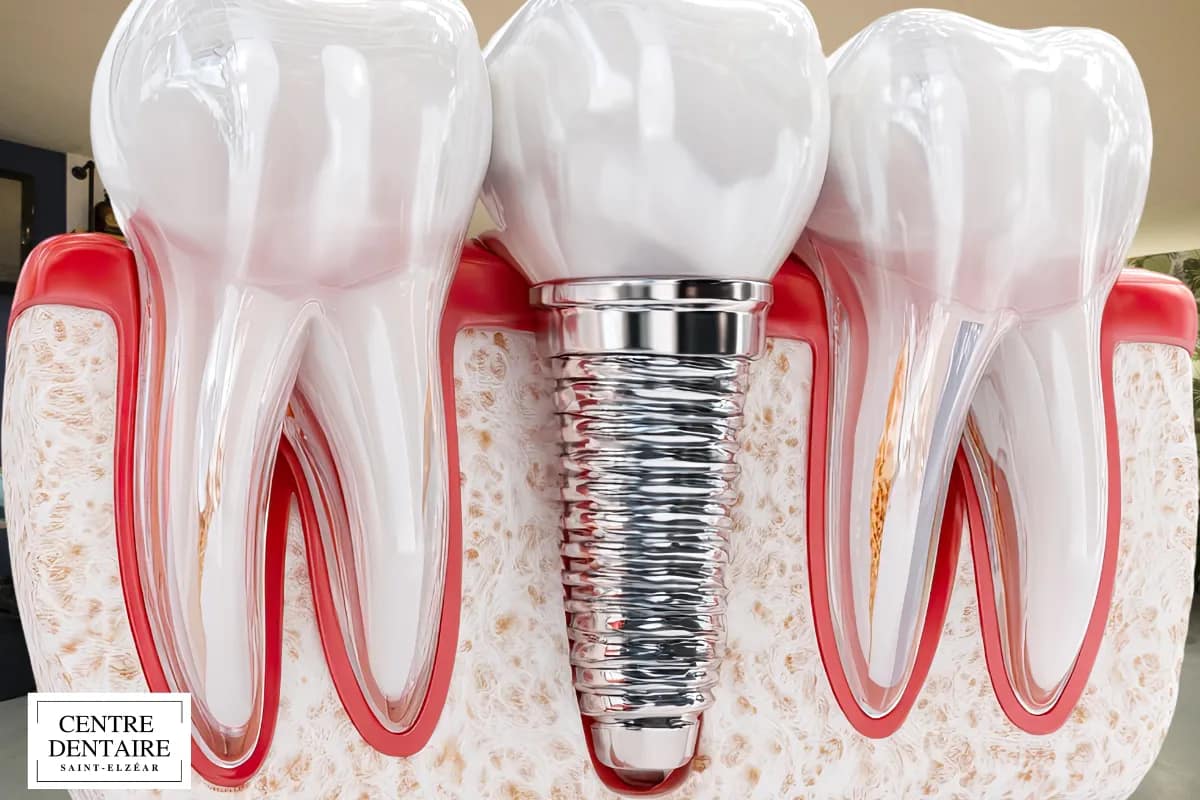 Les implants chez les personnes âgées