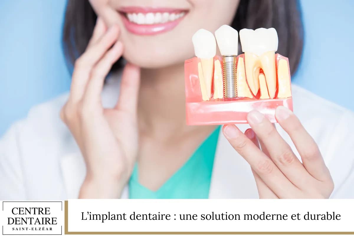 L’implant dentaire : une solution moderne et durable